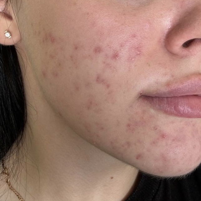 Після процедури