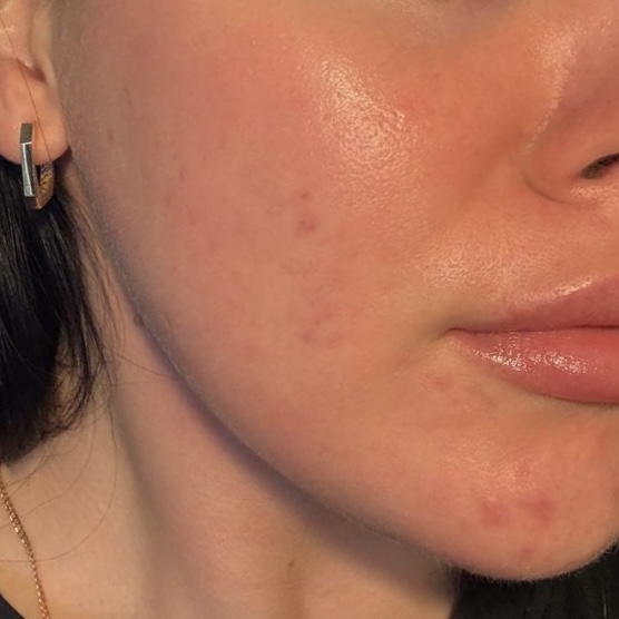 До процедури