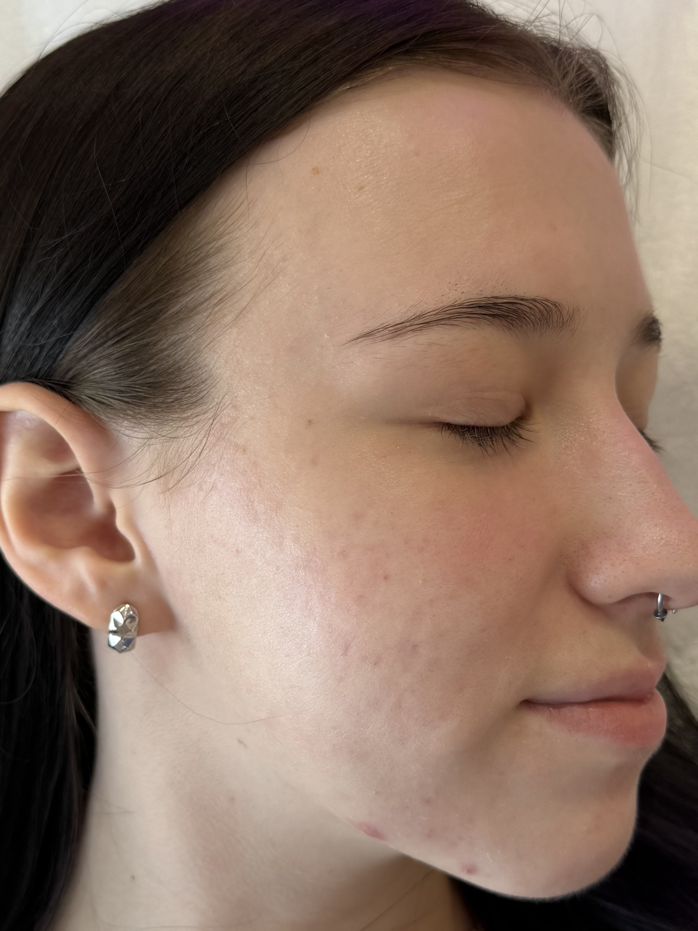 Після процедури